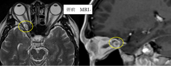 術前MRI