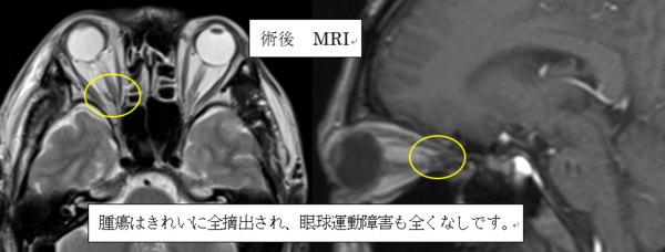術後MRI