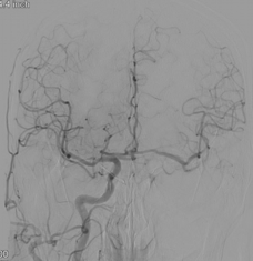 DSA（右総頸動脈造影）：右内頸動脈の血流が前交通動脈を介し、左大脳半球へ遅れて造影される血流が確認できます。