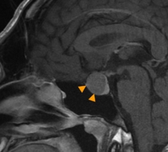 下垂体腺腫のMRI