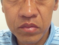 特徴的な鼻翼の増大と分厚くなった口唇の写真