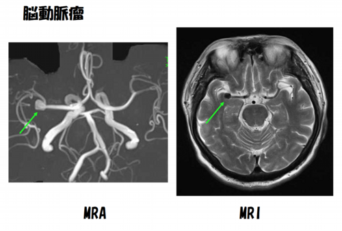 脳動脈瘤 MRA/MRI画像