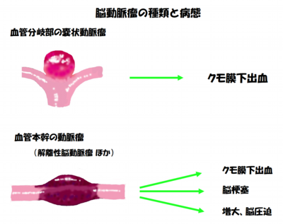 脳動脈瘤 昭和大学医学部 脳神経外科学教室の脳動脈治療