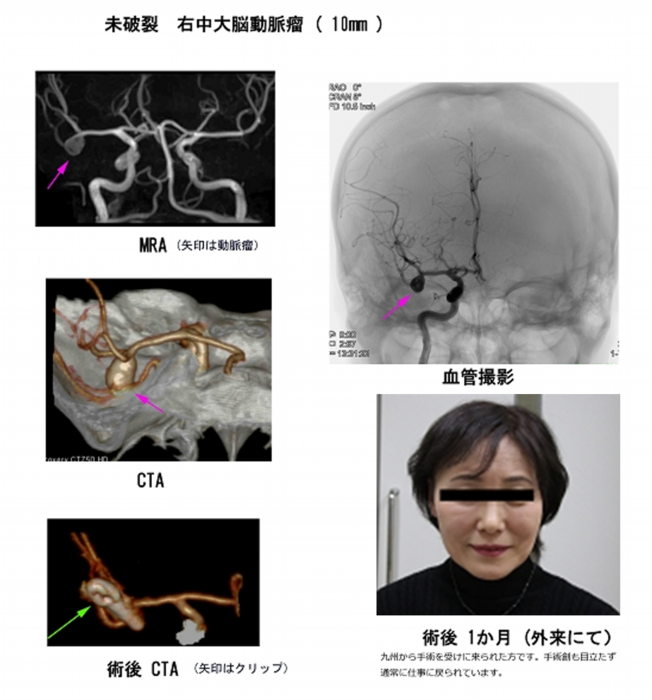 未破裂 右中大脳動脈瘤（10mm）