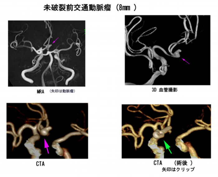 未破裂 前交通動脈瘤（8mm）