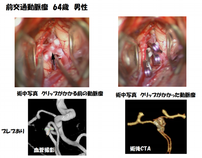 前交通動脈瘤 64歳男性