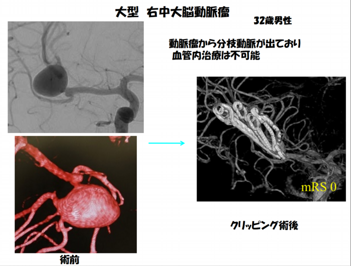 大型 右中大脳動脈瘤 32歳男性