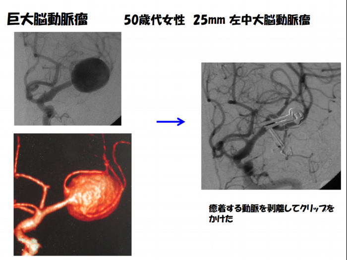 巨大動脈瘤 50歳代女性 25mm左中大動脈瘤