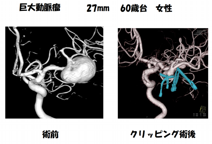 巨大動脈瘤 60歳代女性
