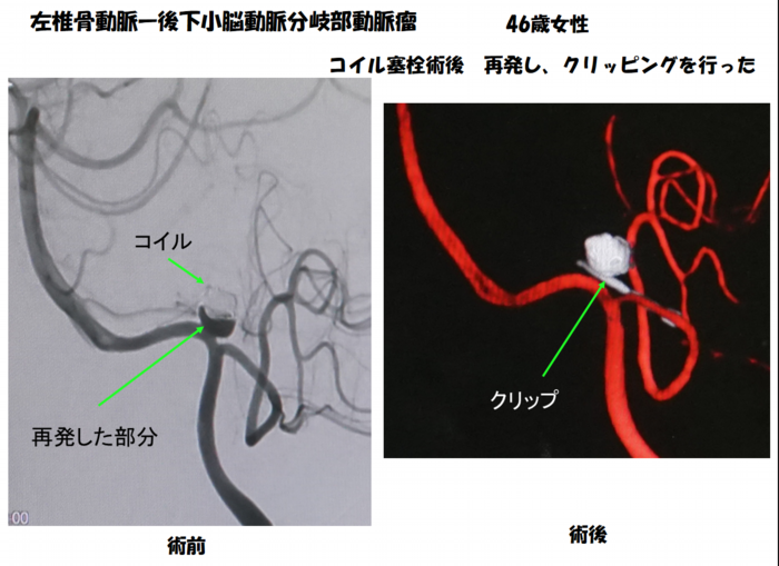 左椎骨動脈-後下小脳動脈分分岐部動脈瘤 46歳女性