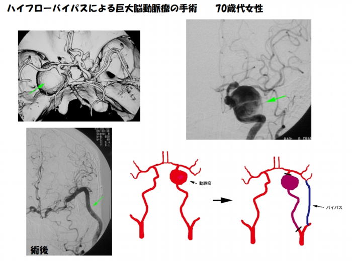 ハイブローバイパスによる巨大動脈瘤の手術 70歳代女性