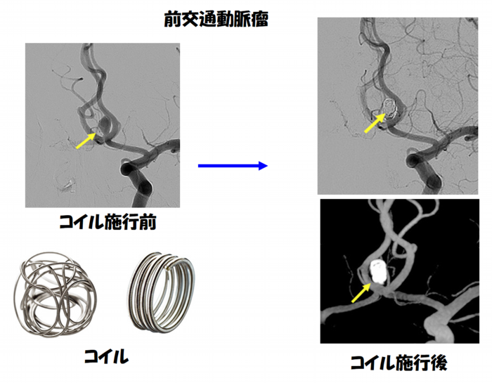 前交通動脈瘤