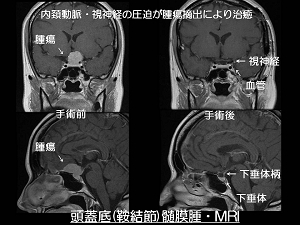 頭蓋底（鞍結節）髄膜腫・MRI