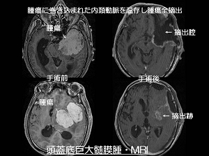 頭蓋底巨大髄膜腫・MRI