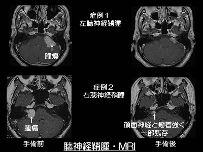 聴神経鞘腫・MRI