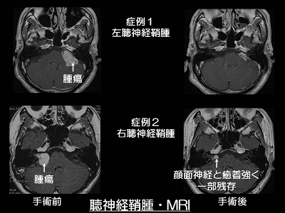 脳腫瘍（良性）・頭蓋底腫瘍・眼窩内腫瘍