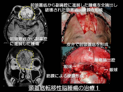 頭蓋底転移性脳腫瘍の治療1