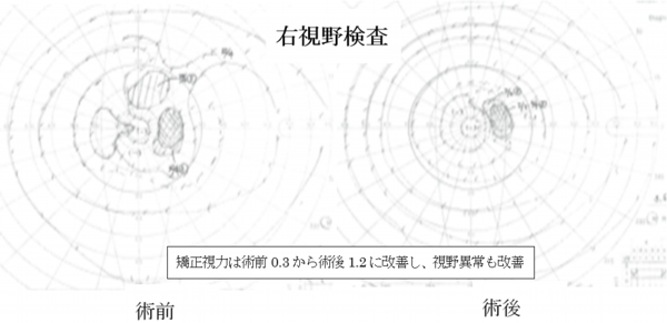 右視野検査