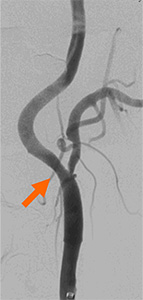 血管造影：ステント治療後 内頚動脈の細くなっていた部分が拡張している