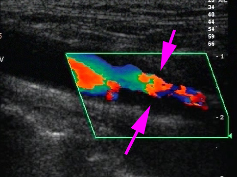 血管超音波検査（頚動脈エコー）