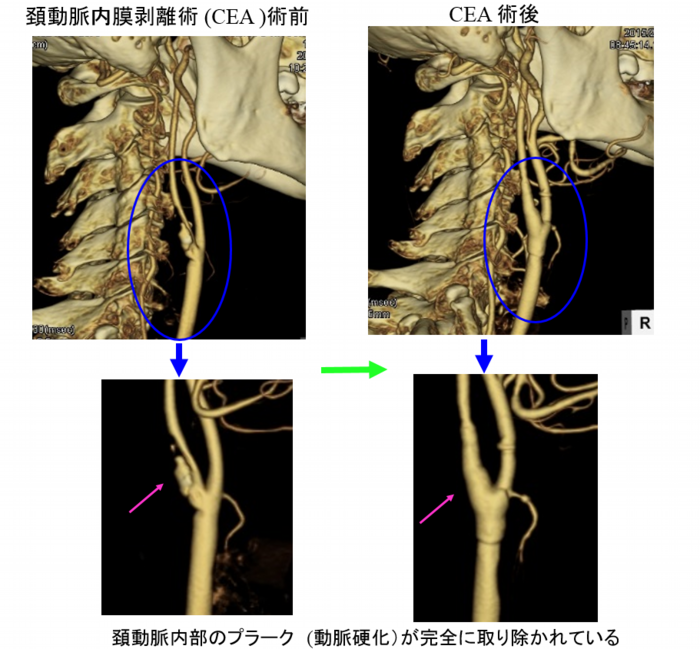 頚動脈内膜剥離術（CEA）術前と術後