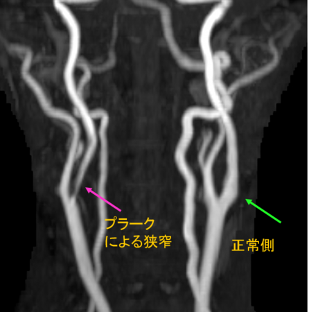 頚部動脈MRI・MRA、プラーク性状診断