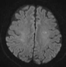 頭部MRI：左大脳半球に小さい新鮮な脳梗塞を認めます。