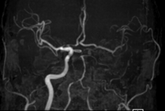 頭部MRA：左内頸動脈から左中大脳動脈（MCA）にかけての描出が不明瞭です。