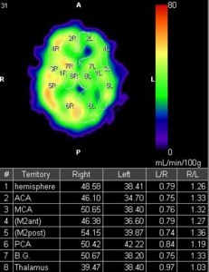 SPECT（脳血流シンチ）：左大脳半球の血流が対側と比較し20-30％低下しています。