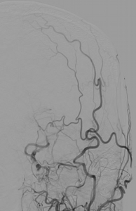 DSA（左総頸動脈造影）：左内頚動脈から左中大脳動脈（MCA）の描出は不明瞭ですが、皮膚の浅側頭動脈（STA）が良好に確認できます。