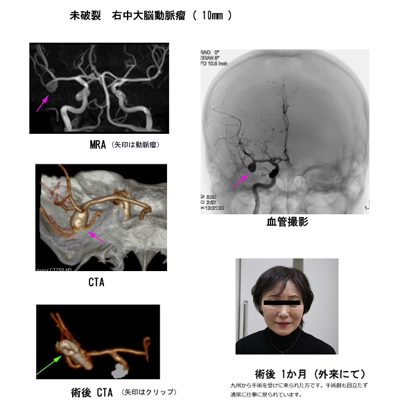 動脈瘤の治療方法（1）開頭手術