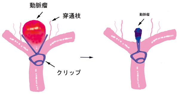 動脈瘤