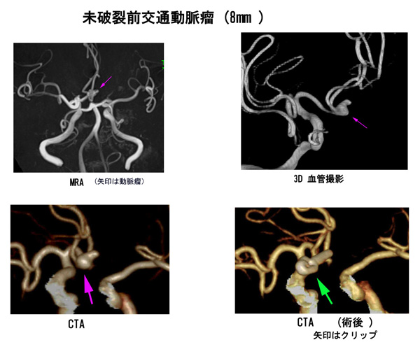 未破裂前交通動脈瘤（8mm）