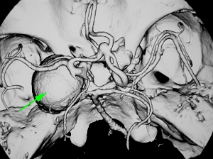 術前 ヘリカルCT：矢印は動脈瘤