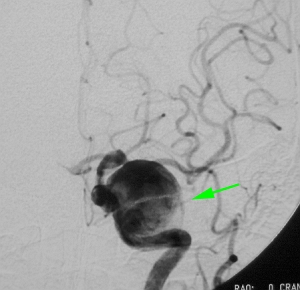 術前 血管撮影：矢印は動脈瘤