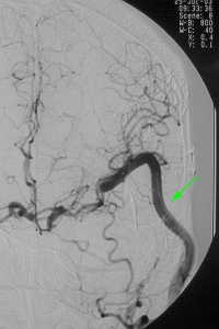 術後 血管撮影 動脈瘤は消失、矢印はバイパス