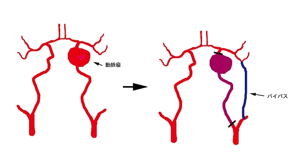動脈瘤・バイパスイラスト