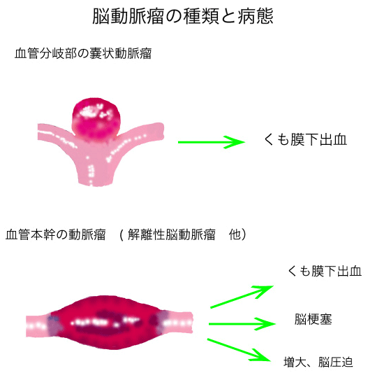 脳動脈瘤の種類と病態