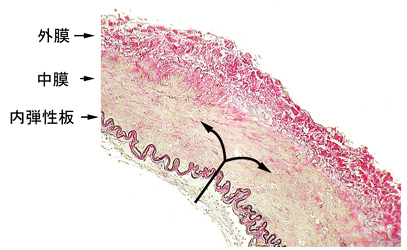 正常の脳動脈の構造と、動脈解離の発生