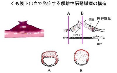 くも膜下出血で発症する解離性脳動脈瘤の構造