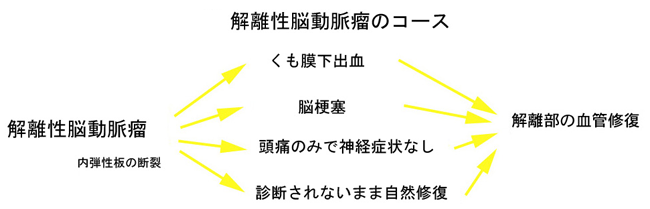 解離性脳動脈瘤のコース