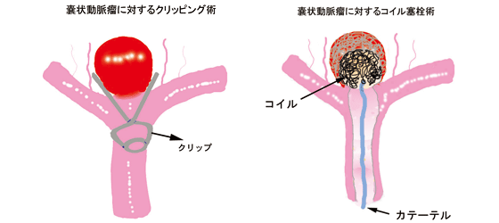 嚢状動脈瘤に対するクリッピング術 嚢状動脈瘤に対するコイル塞栓術