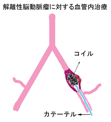 解離性脳動脈瘤に対する血管内治療