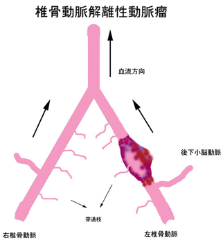 椎骨動脈解離性動脈瘤