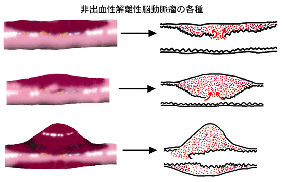 非出血性解離性脳動脈瘤の各種