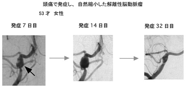 頭痛で発症し、自然縮小した解離性脳動脈瘤