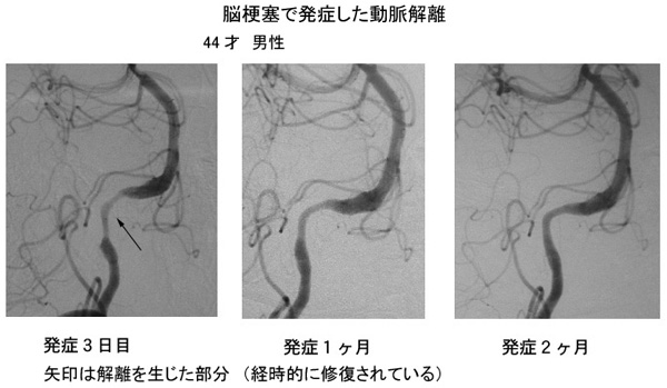 脳梗塞で発症した動脈解離