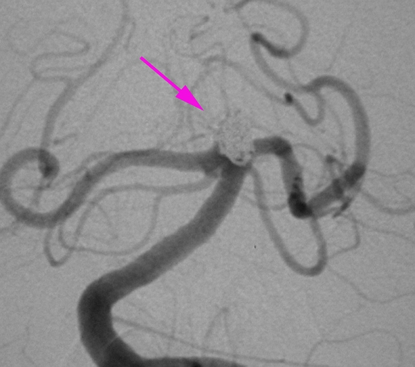コイル塞栓術後の動脈瘤