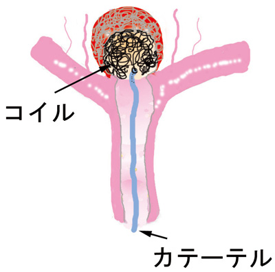 コイル塞栓術（図4）