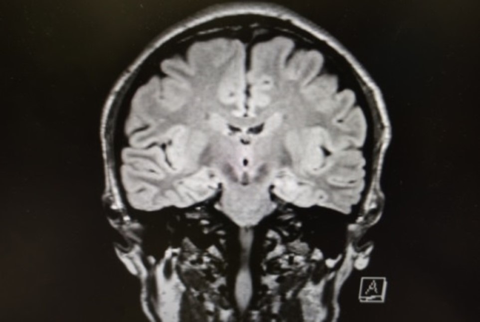 術前MRI画像